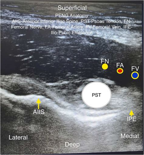 Pericapsular Nerve Group Peng Block Results In Significant Opioid