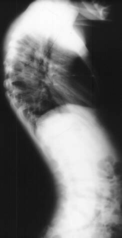 KYPHOSCOLIOSIS IN NEUROFIBROMATOSIS