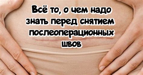 Всë то, о чем надо знать перед снятием послеоперационных швов | Просто ...