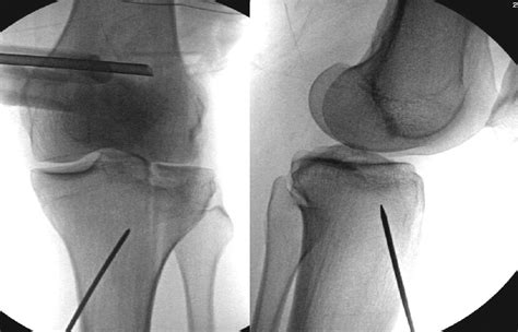 Arthroscopic Assisted Reduction And Percutaneous Fixation Of Tibial