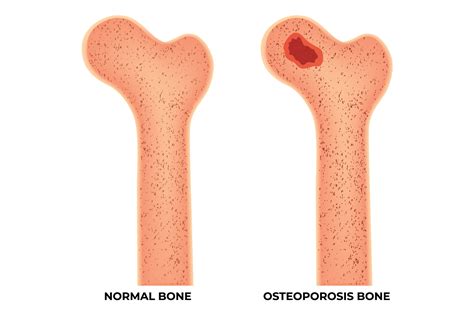 normal bone  osteoporosis bone design graphic  hamjaiu creative