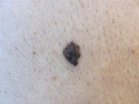 Melanoma Skin Cancer On Arm