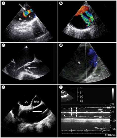 Transoesophageal Echocardiographic Evaluation Of Type B Aortic