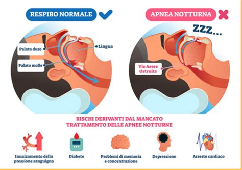 Cosa Sono Le Apnee Nel Sonno Studio Alessandri Bonetti Giunta