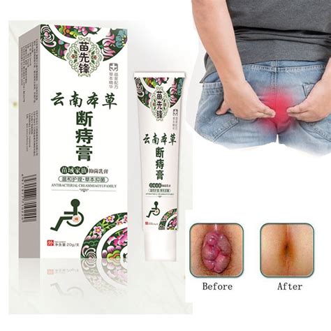 Anal Fissure Treatment Hemorrhoid Ointment Herbal Cream Natural Chinese Medicine Suppository