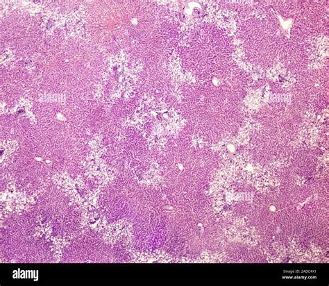 Light Micrograph Of Fatty Liver Disease This Is Periportal Zone