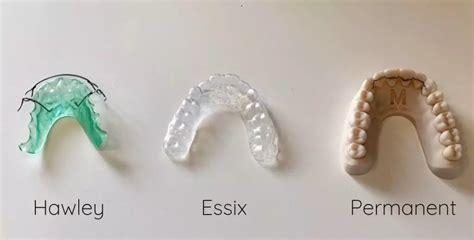 Tipos De Retenedores Dentales Cl Nica Ruiz De Gopegui