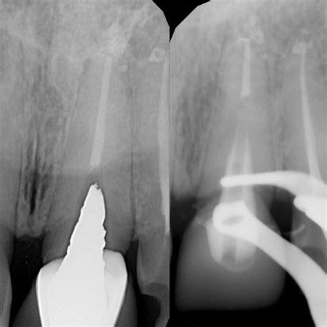 В чем разница между металлокерамическими и керамическими коронками ...