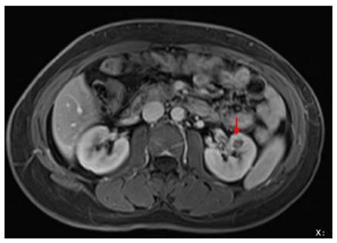 Magnetic resonance imaging (MRI) shows a mass in the left kidney (red ...