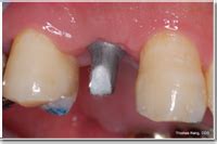 Implant Technology Puget Sound Periodontics Thomas Kang Dds