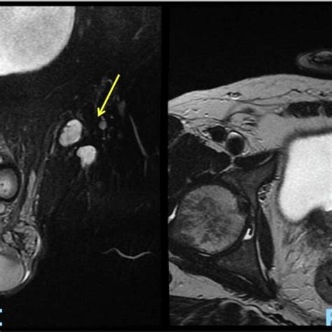 Computed Tomography Showed Enlarged And Heterogeneous Bilateral