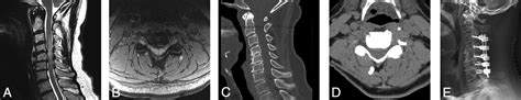 Counterpoint Appropriately Ambiguous—the Disc Osteophyte Complex American Journal Of