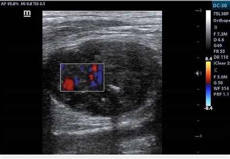 Doppler Ultrasonography Image Demonstrating Color Uptake Within The