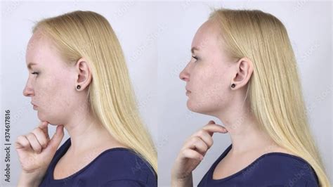 Vidéo Stock Second Chin Lift In Women Photos Before And After Plastic