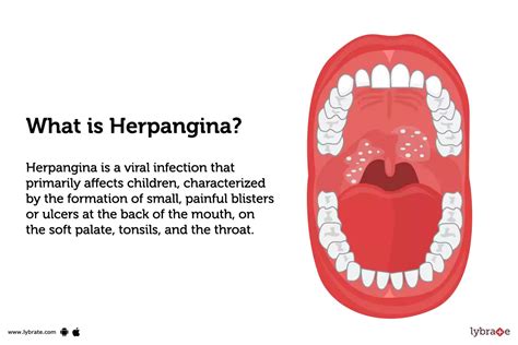 What Causes Blisters In Throat