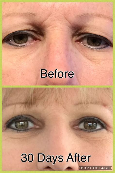 Eye Lid Surgery Eye Doctor In Brandon Fl Brandon Eye Associates