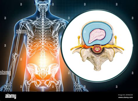 Hernie lombaire et vertèbre avec disque hernié diagramme médical 3D