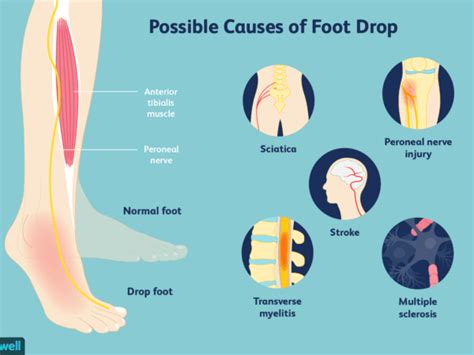 Whats Causing Your High Steppage Gait Symptom Not Problem
