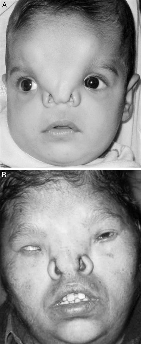 A And 3b Two Cases With Bilateral Nasal Clefts With Bilateral Cranial Download Scientific