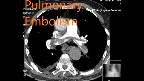 Hemodynamics And Resuscitation In Pulmonary Embolism YouTube