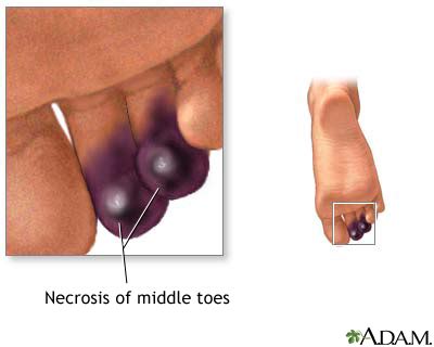 Necrotic Tissue Toe