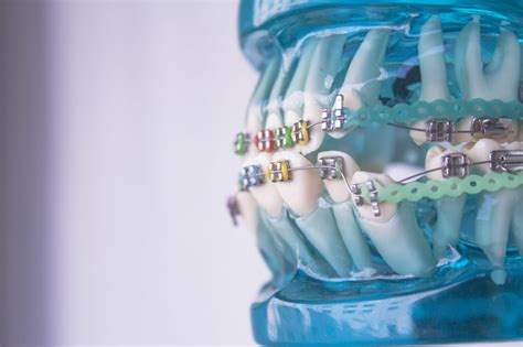 How Do Your Teeth Move Blue Ridge Orthodontics