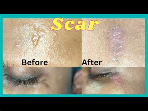 Laser Scar Revision Surgery Laser Treatment Of Scar Scar Revision