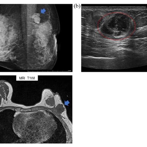 Pdf Recurrent Malignant Phyllodes Tumor Of The Breast An Extremely