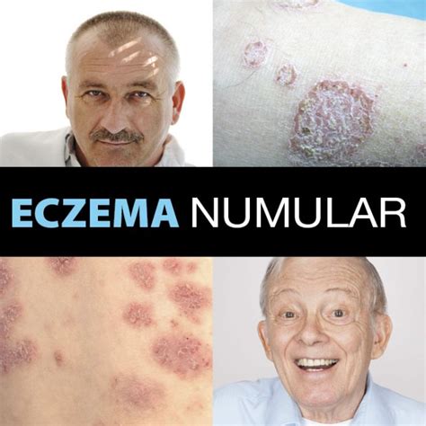 Eczema numular causas síntomas diagnóstico y tratamiento La Guía