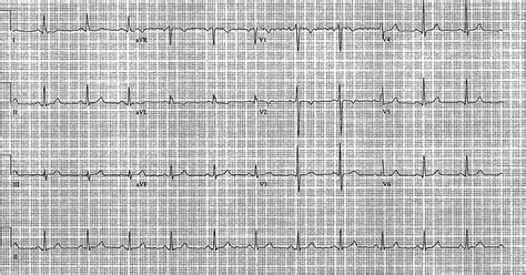 Dextrocardia Cardio Guide