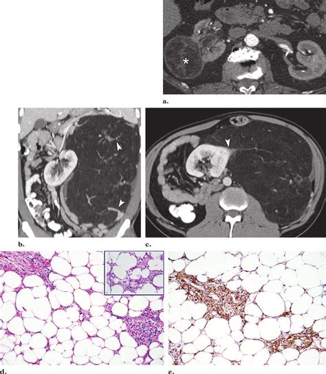 Angiomyolipoma A Ct Scan Shows A Fat Containing Mass That Is Clearly