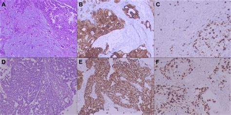 A Histology Of Primary Carcinoma Ex Pleomorphic Adenoma B