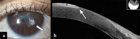 Hr Oct Helps Detect Ocular Surface Squamous Neoplasia Ophthalmology