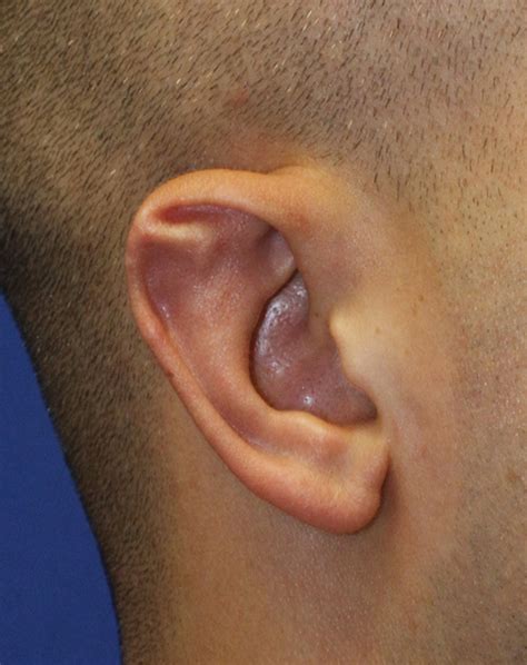 Otoplasty Seattle Facial Plastic Surgeon Dr Lamperti Seattle Wa