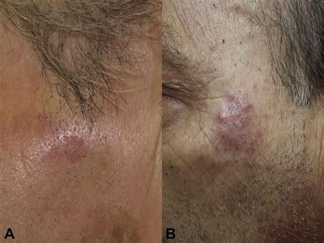 Clues For Differentiating Discoid Lupus Erythematosus From Actinic