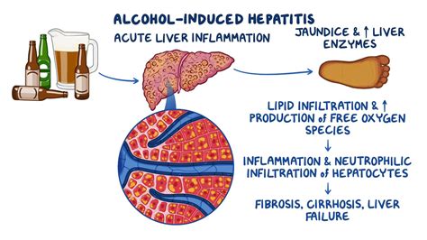 Alcoholic Hepatitis Liver