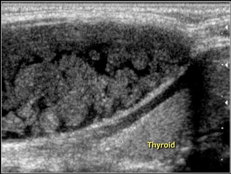 Dermoid Cyst Neck