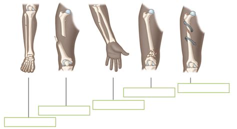 8 Types Of Bone Fractures