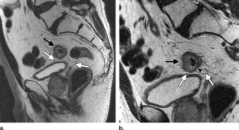 Value Of High Resolution Multiplanar Imaging A Routine Sagittal