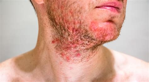 Dermatitis seborreica qué es síntomas y tratamientos IDP Dermocosmética