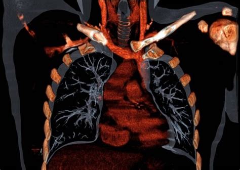 Unusual Anatomical Causes Of Malposition Of Central Venous Catheters