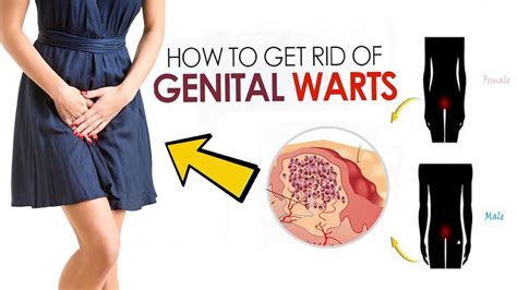 How To Get Rid Of Genital Warts Home Remedies For Genital Warts