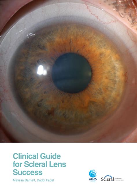 Clinical Guide For Scleral Lens Success Melissa Barnett Daddi Fadel 2