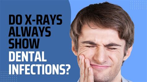 Infected Tooth Xray Are Dental Infections Always Seen On A X Ray