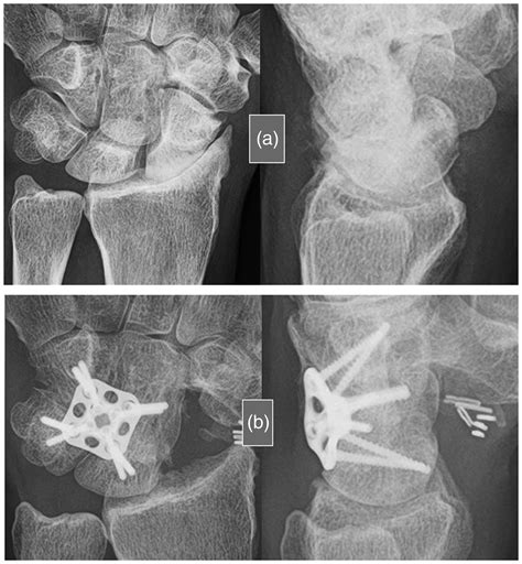 Four Corner Arthrodesis With A Dorsal Locking Plate 49 Year Follow Up