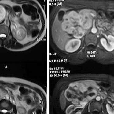 Scrotal Anatomy Ultrasound