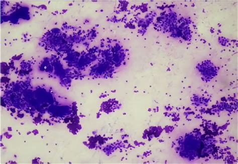 Histopathology Multinucleated Giant Cells With More Than 10 Roundoval