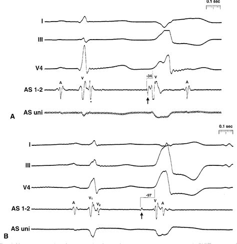 Monomorphic Ventricular Tachycardia By Ecg Finding Semantic Scholar