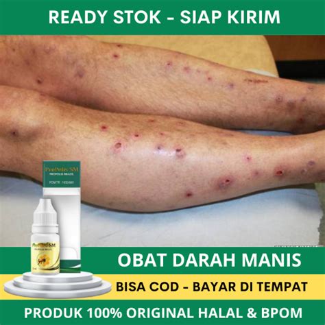 Jual Obat Darah Manis Bentol Prurigo Penyakit Kulit Kulit Gatal