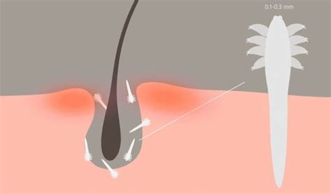 What Are Demodex Mites